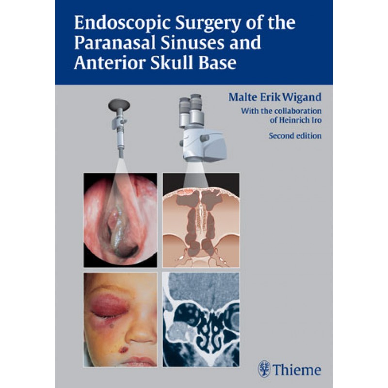 Endoscopic Surgery of the Paranasal Sinuses and Anterior Skull Base