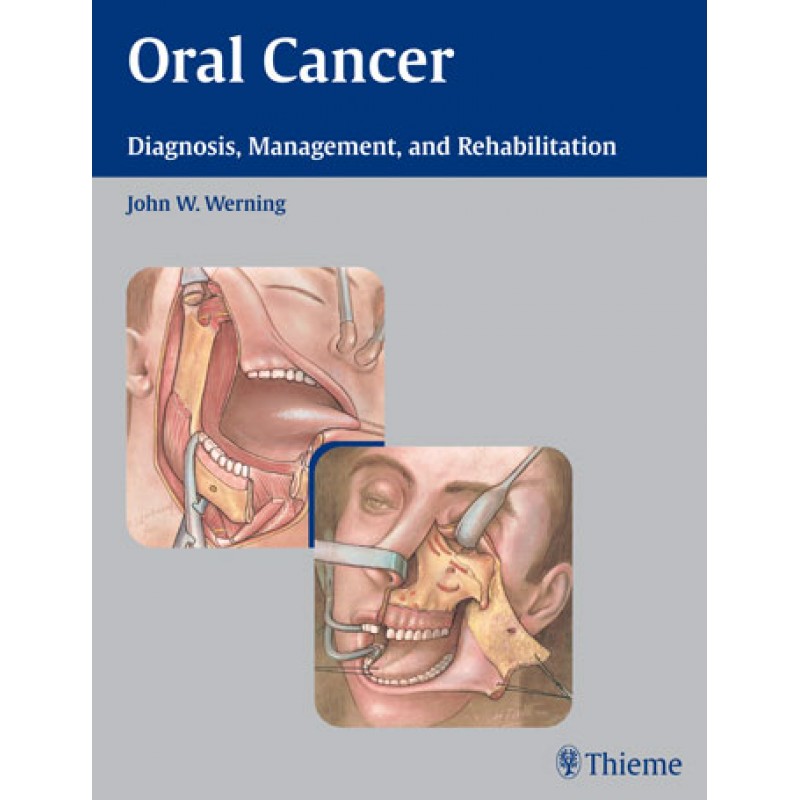 Oral Cancer Diagnosis, Management, and Rehabilitation