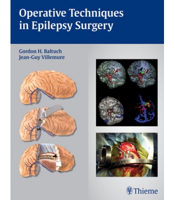 Operative Techniques in Epilepsy Surgery