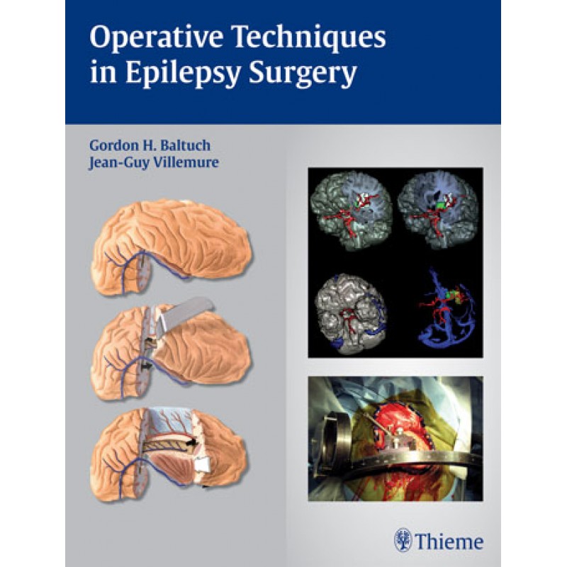 Operative Techniques in Epilepsy Surgery