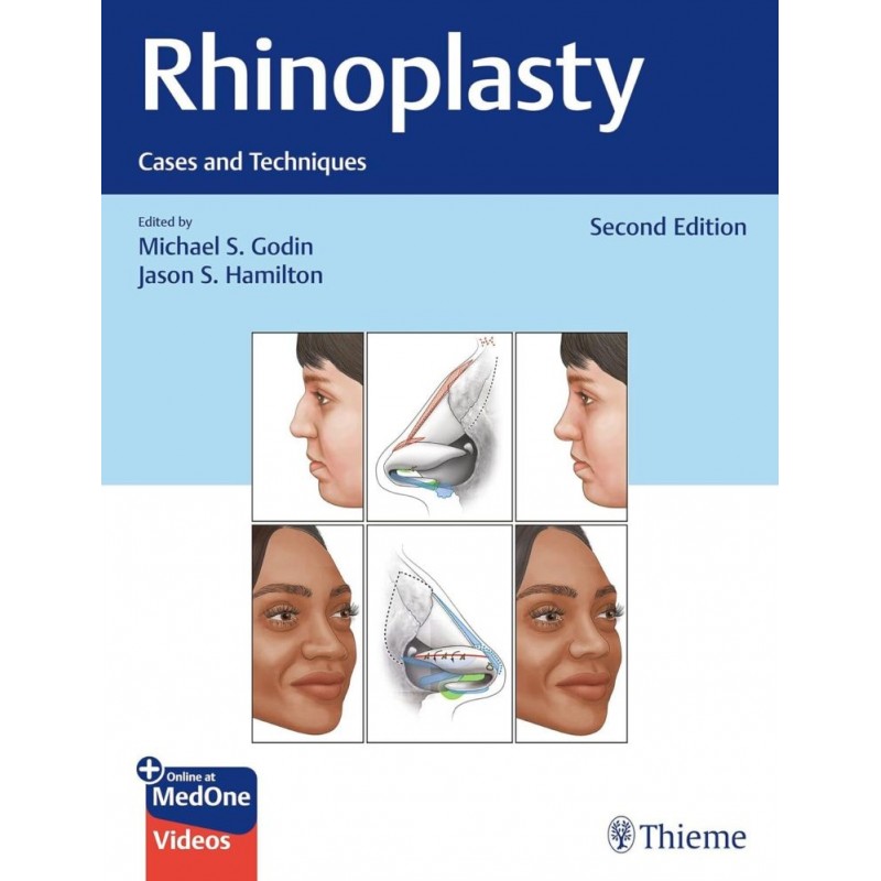 Rhinoplasty. Cases and Techniques