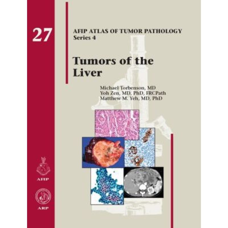 Tumors of the Liver