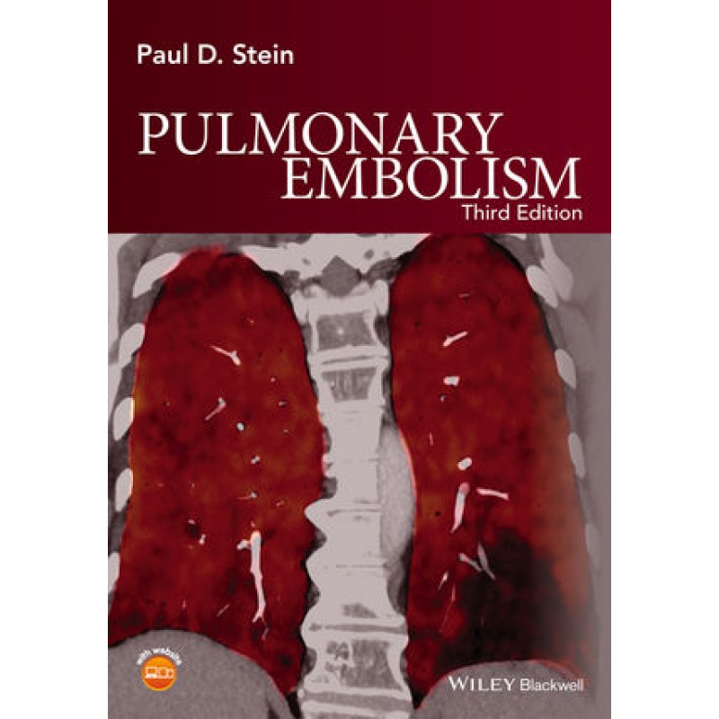 Pulmonary Embolism, 3rd Edition